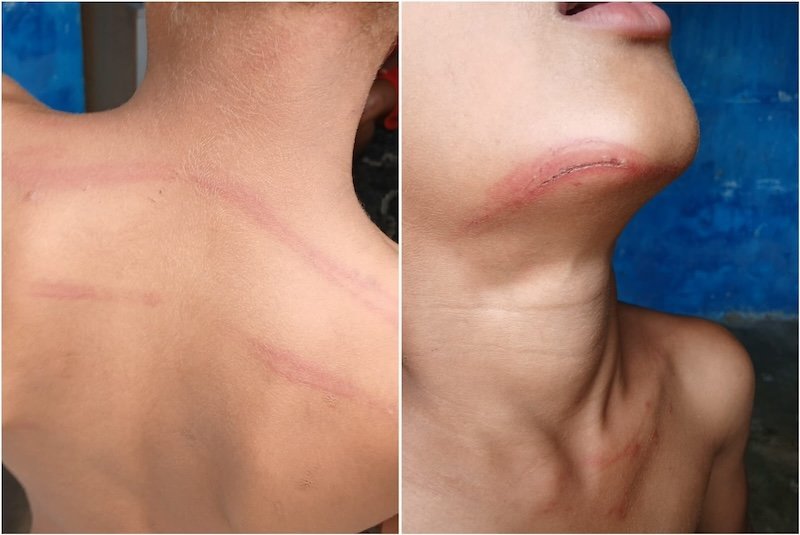 Professor é denunciado por agredir garoto de 8 anos com cipó de goiabeira em Ilhéus