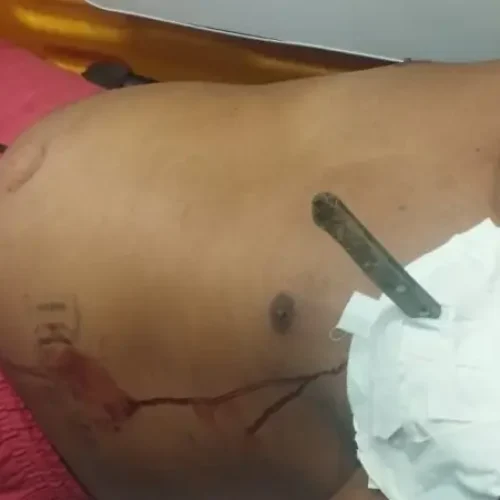 FACA CRAVADA NO PEITO! Homem de 24 anos é socorrido após tentativa de homicídio em Gongogi
