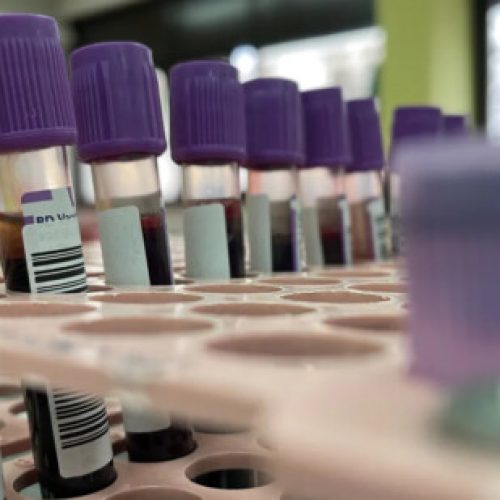 Estudo aponta que jejum prolongado pode ser desnecessário em diversos exames de sangue