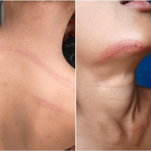 Professor é denunciado por agredir garoto de 8 anos com cipó de goiabeira em Ilhéus